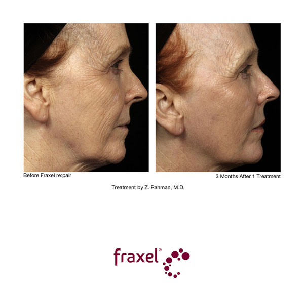 Vorher / Nachher Bilder von beispielhaften Fraxel re:pair Behandlungen